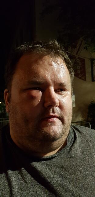 Blatt-Gold-Reporter Sascha Nowak wurde von einer Biene gestochen. Sascha sagt: "Ich sah aus wie nach einem Box-Kampf."  | Foto: Blatt-Gold